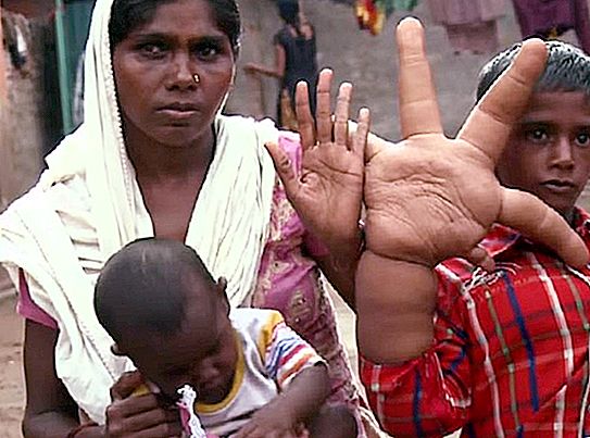 8 kg de dedos - o médico está tentando ajudar o bebê Kalim com as mãos mais gigantes
