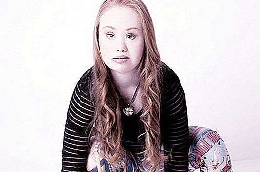 Famous Down Syndrome Model