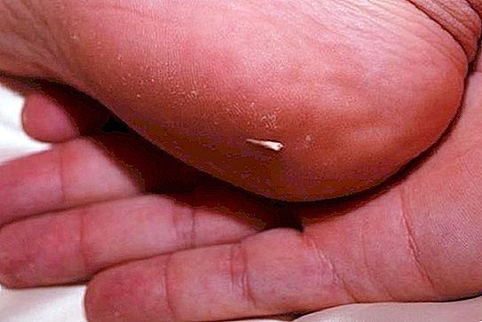 Often tormented by getting splinters: a neighbor doctor suggested how easy it is to remove them
