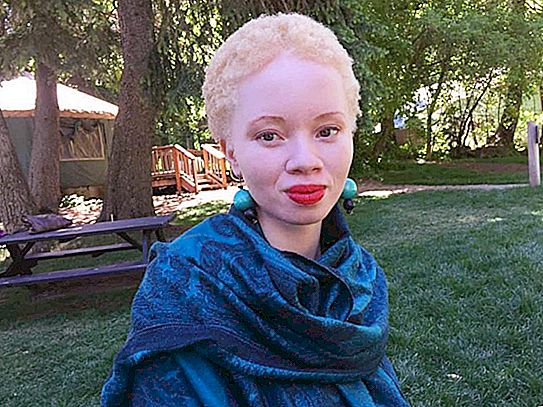 Kecantikan dalam semua bentuknya: sebagai pembela hak asasi manusia dari Afrika telah menjadi model albino yang berjaya