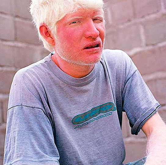 Lelaki Albino: gambar, gambaran penyakit itu