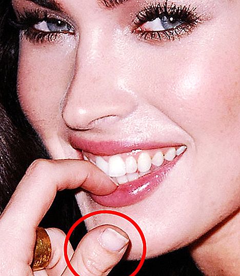 Brachidactyly, or that with a thumb Megan Fox