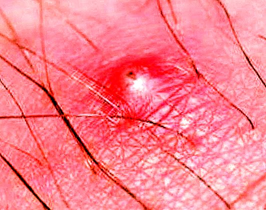 Akne in der Leiste bei Männern: Ursachen und Folgen