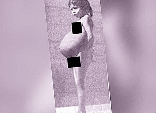 The incredible story of Lina Medina - a girl who became a mother at age 5