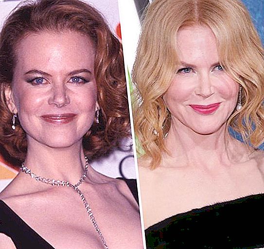 Nicole Kidman: enne ja pärast plastilist operatsiooni (foto)