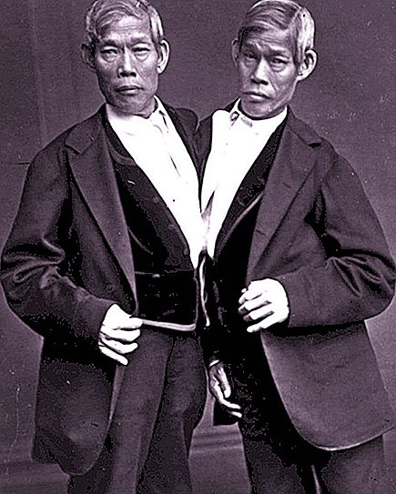 Kembar Siam dan kisah mereka