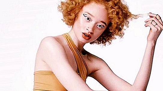 Melalui kesusahan kepada bintang-bintang: bagaimana seorang gadis albino rambut merah yang aneh dari Afrika menjadi model yang dicari di Kanada