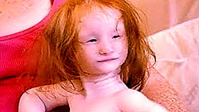 Nejmenší dívka na světě - prvotní trpaslík