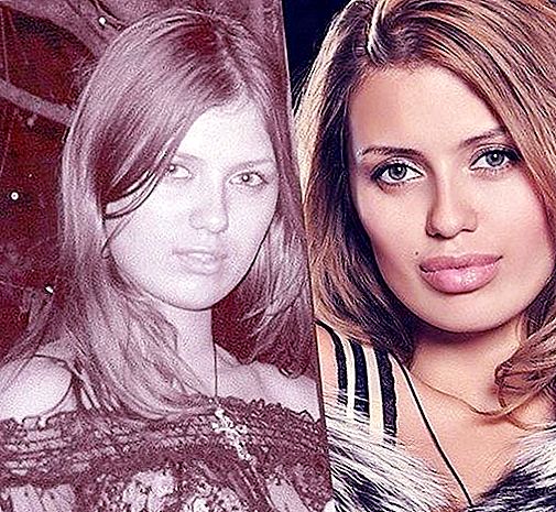 Victoria Bonya înainte și după operația buzelor
